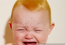 Confirmado primeiro caso de Sarampo em Dracena