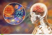 Casos confirmados de Meningite Viral em Dracena