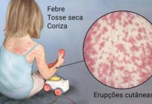 Mais dois casos de Sarampo é registrado em Dracena, dessa vez um casal de 26 anos