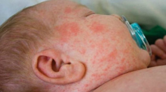 Bebê de 01 ano é diagnosticado com sarampo em Adamantina