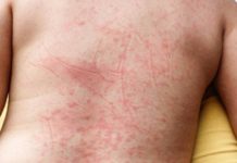 Prefeitura vem a público após divulgação da imprensa sobre 2 mortes por Dengue em Dracena