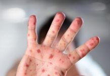 Na sombra da Covid-19, sarampo avança e provoca mortes no Brasil por falta de vacinação