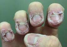 Onicofagia e suas consequências (por Cidinha Pascoaloto)