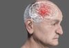 Demência frontotemporal: o que é, como identificar, diagnóstico e tratamento (por Cidinha Pascoaloto)