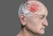 Demência frontotemporal: o que é, como identificar, diagnóstico e tratamento (por Cidinha Pascoaloto)