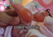 Bebê sofre queimaduras ao fazer o “Teste do Pezinho” em Panorama. Prefeitura divulga nota